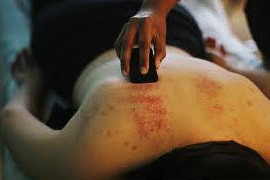 Gua Sha marks